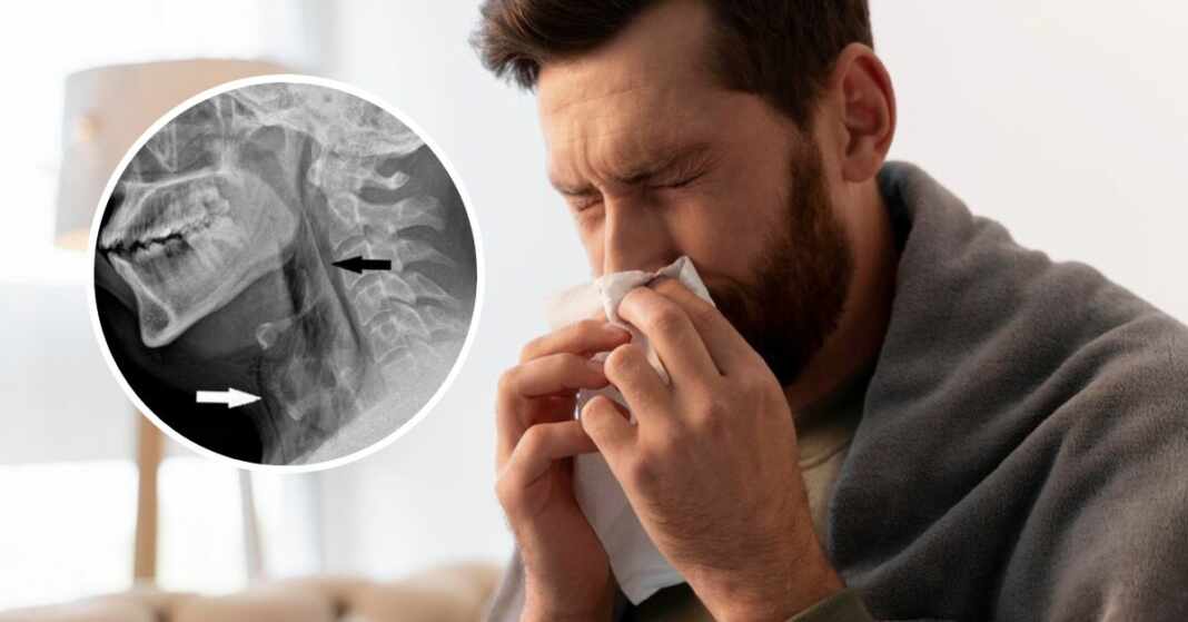 primer caso en el mundo hombre perforación tráquea por reprimir un estornudo