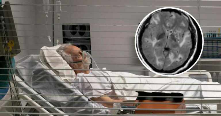 hombre tenía gusanos en el cerebro por comer tocino crudo, enfermedad por comer cerdo crudo, gusanos en el cerebro