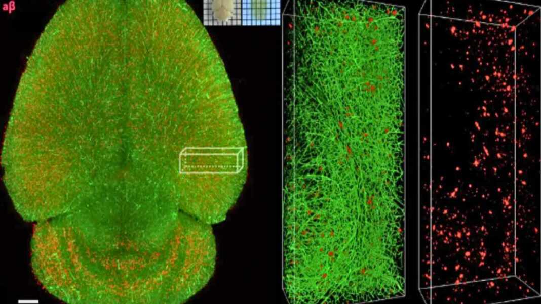 Científicos logran eliminar las placas del Alzheimer y restaurar la memoria en estudios preclínicos