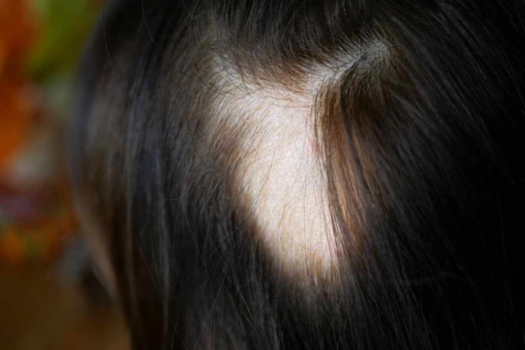 Primer plano del cuero cabelludo, zona afectada por la alopecia areata